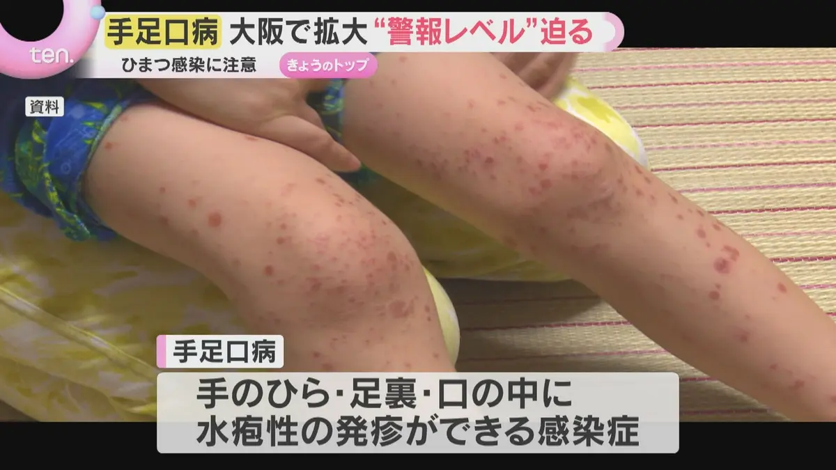 日テレNEWS NNN 7月3日(金) 17:42 手足口病が大阪で急拡大“警戒レベル